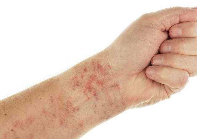 12 dấu hiệu cảnh báo bệnh lupus ban đỏ
