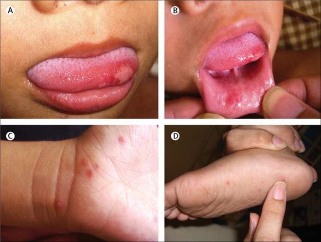 4 sai lầm khi chăm sóc trẻ mắc bệnh tay chân miệng