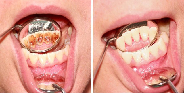 8 sai lầm phổ biến khi chăm sóc răng