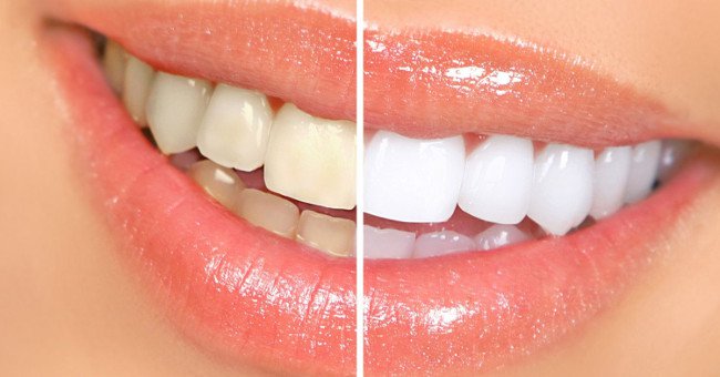9 cách làm răng trắng hơn