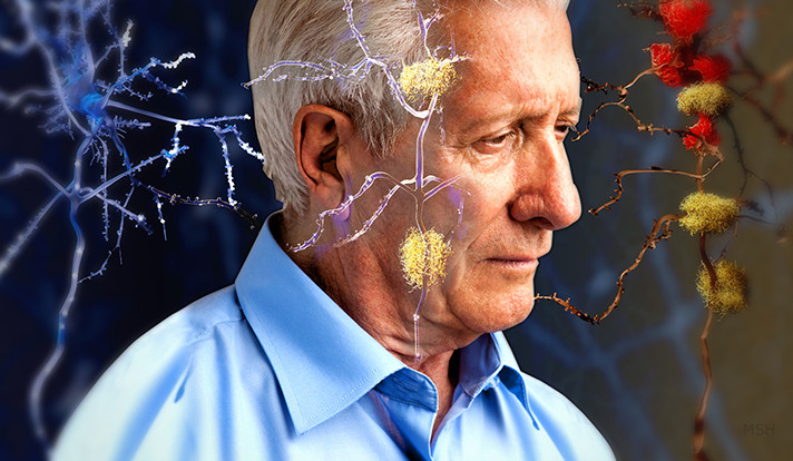 Alzheimer cũng có nhiều loại khác nhau