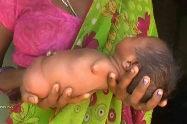 Bé gái Sọ Dừa phiên bản Ấn Độ sinh ra đã giống cục thịt không có tay chân