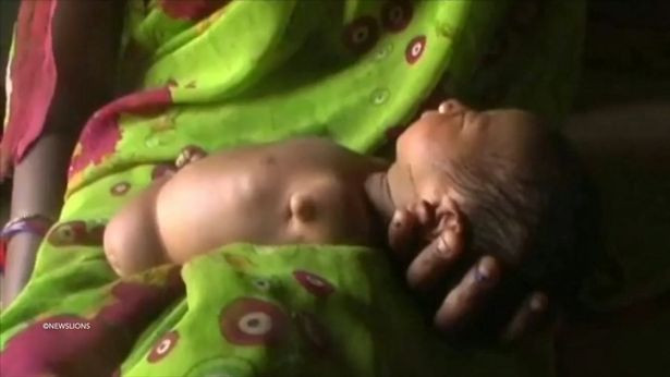 Bé gái Sọ Dừa phiên bản Ấn Độ sinh ra đã giống cục thịt không có tay chân