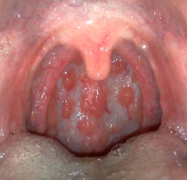 Bệnh viêm họng hạt là gì?