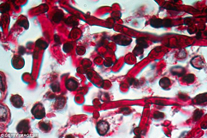 Các bác sĩ Mỹ lo ngại về một chủng nấm gây nhiễm trùng chết người mới
