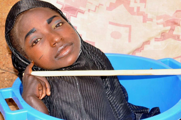 Cô gái Sọ Dừa ở Nigeria đã qua đời đúng ngày lễ Giáng sinh