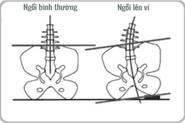 Để ví vào túi quần sau là nguyên nhân gây đau lưng