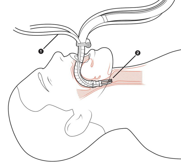 Flex - Robot rắn chui vào cơ thể qua đường miệng để phẫu thuật