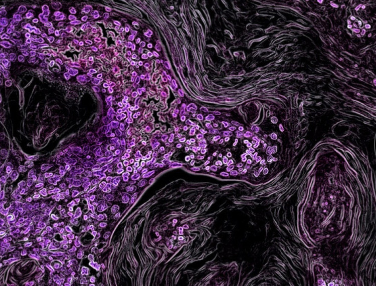 Hình ảnh tế bào ung thư dưới kính hiển vi