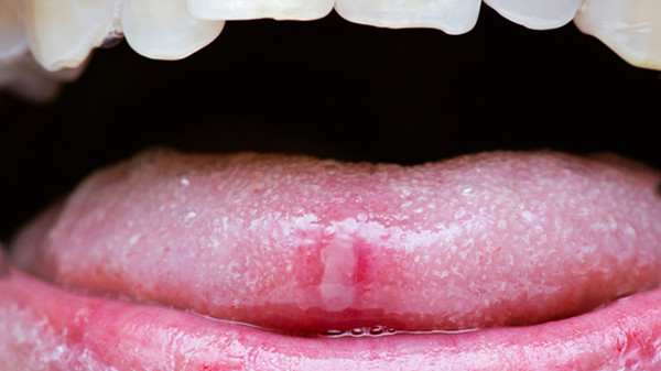 Khoang miệng nhiều vi khuẩn nhưng sao vết thương cắn vào lưỡi lại không bị nhiễm trùng?
