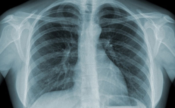 Kiểm tra lao phổi không cần chụp X-quang nhờ thiết bị mới