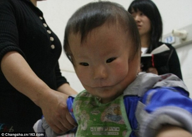 Mắc dị tật cực hiếm, em bé mang hai khuôn mặt