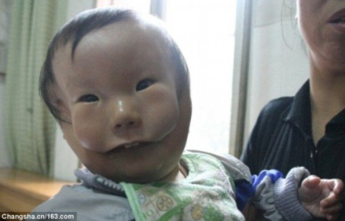 Mắc dị tật cực hiếm, em bé mang hai khuôn mặt