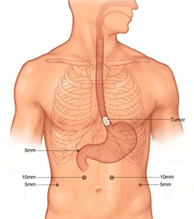 Nếu lười thực hiện thói quen này mỗi ngày, bạn có thể bị ung thư thực quản