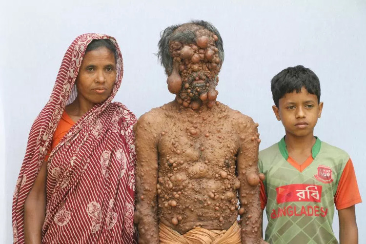 Người đàn ông trăm u bị xa lánh ở Bangladesh