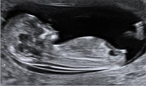 Phát hiện hội chứng Down khi thai nhi chỉ mới từ 11 đến gần 14 tuần