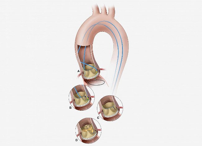 Phương pháp mới giúp thay thế van tim an toàn hơn