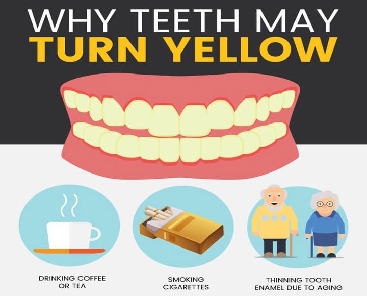 Tại sao răng chúng ta bị ngả sang màu vàng?