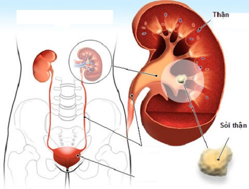 Tất cả những điều bạn cần biết về bệnh sỏi thận