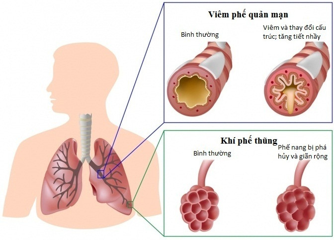 Ứng dụng tế bào gốc trong điều trị bệnh phổi tắc nghẽn mãn tính
