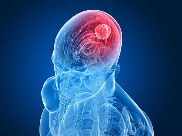 Ung thư não, triệu chứng và dấu hiệu nhận biết