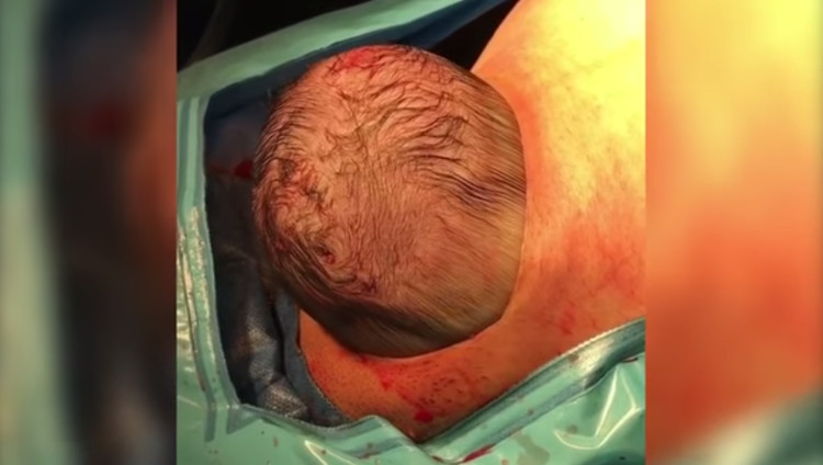 Video: Em bé tự chui đầu ra khỏi bụng mẹ