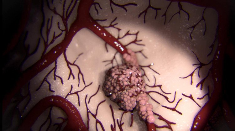 Video: Tận mắt xem các tế bào ung thư lan khắp cơ thể