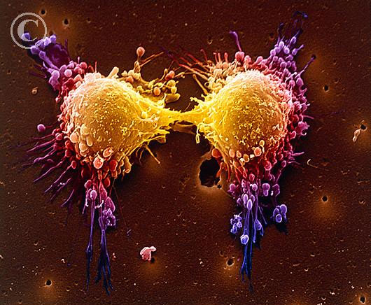 5 biến thể gen liên quan tới ung thư tiền liệt tuyến