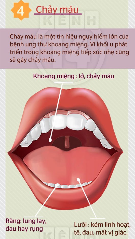 7 dấu hiệu mách lẻo căn bệnh ung thư miệng