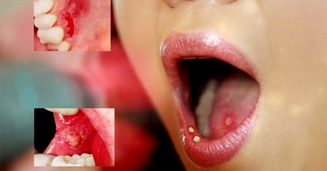 7 dấu hiệu mách lẻo căn bệnh ung thư miệng