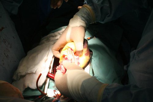 Bác sĩ người Việt ghép tim thành công