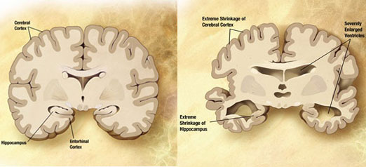 Bệnh Alzheimer có thể phòng ngừa được