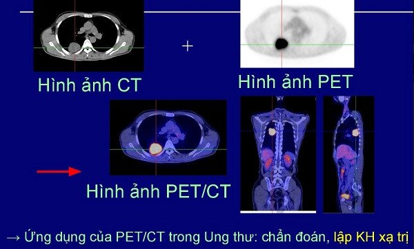 Bệnh nhân ung thư phổi di căn khắp cơ thể vẫn chữa khỏi