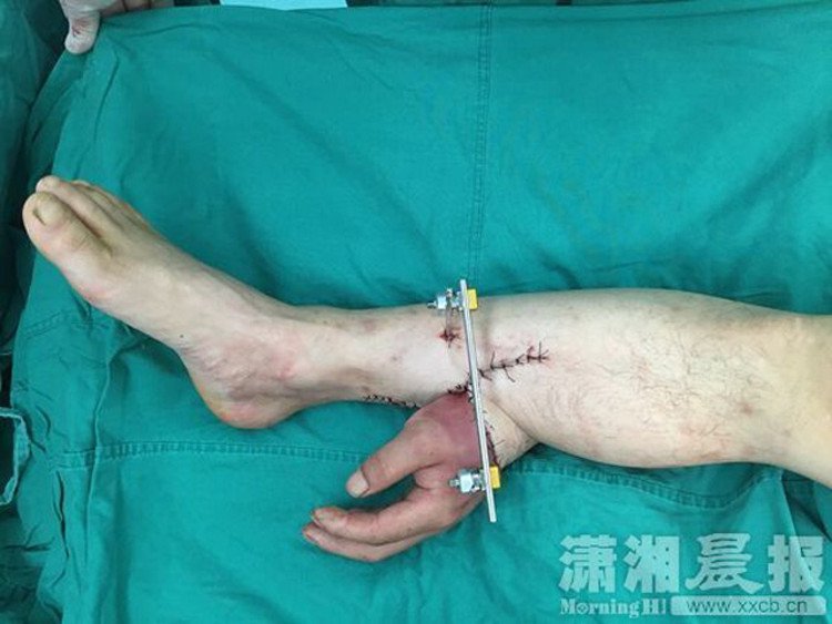 Ca cấy ghép hi hữu bàn tay được nuôi dưỡng trên chân