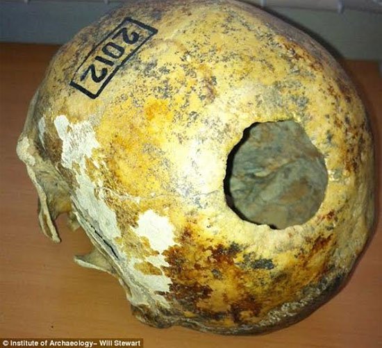 Ca phẫu thuật hộp sọ kỳ bí cách đây 2300 năm
