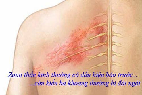 Cách xử lý vết thương do kiến ba khoang gây ra đơn giản mà không cần đến viện