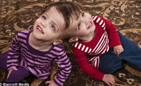 Cặp sinh đôi dính đầu có thể nhìn qua mắt của nhau