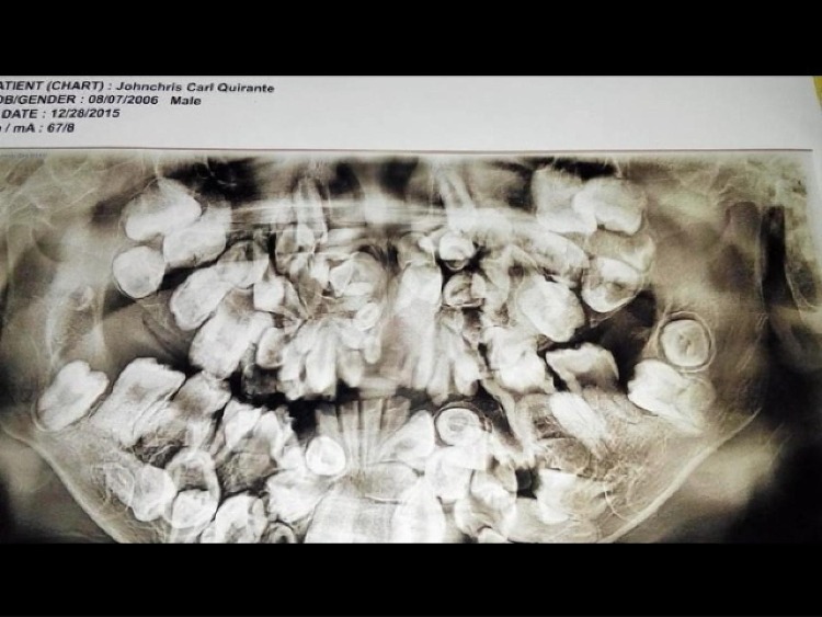 Cậu bé 9 tuổi mắc triệu chứng lạ, có tới 300 chiếc răng