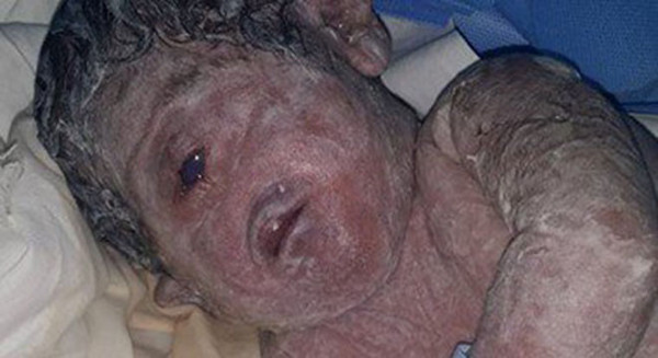 Chuyện lạ: Bé trai một mắt chào đời ở Ai Cập