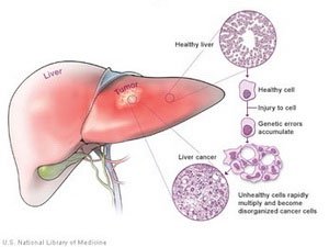 Công bố phát hiện quan trọng về bệnh ung thư gan
