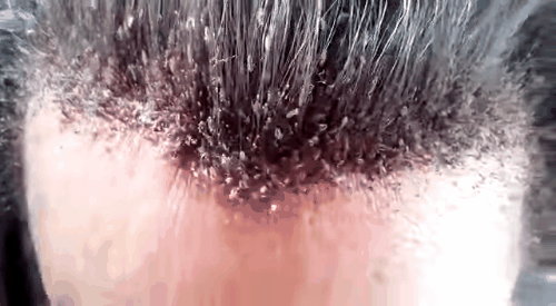 Đại dịch chấy tóc sắp bùng nổ khi 98% chấy rận đã kháng thuốc