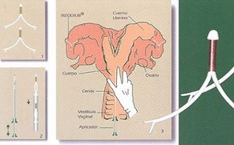 Đặt vòng cho bò để tăng năng suất sản xuất thịt