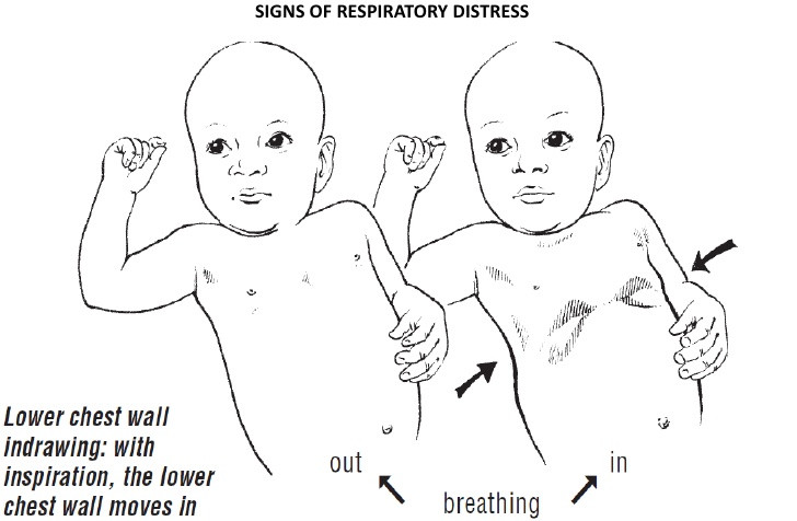 Dấu hiệu nhận biết sớm viêm phổi ở trẻ trong mùa lạnh