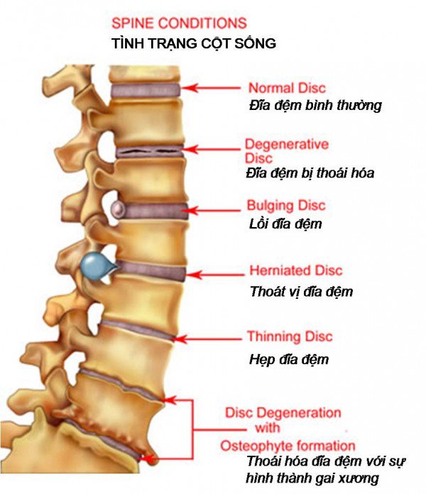 Gai xương cột sống thắt lưng, một biểu hiện của thoái hóa cột sống