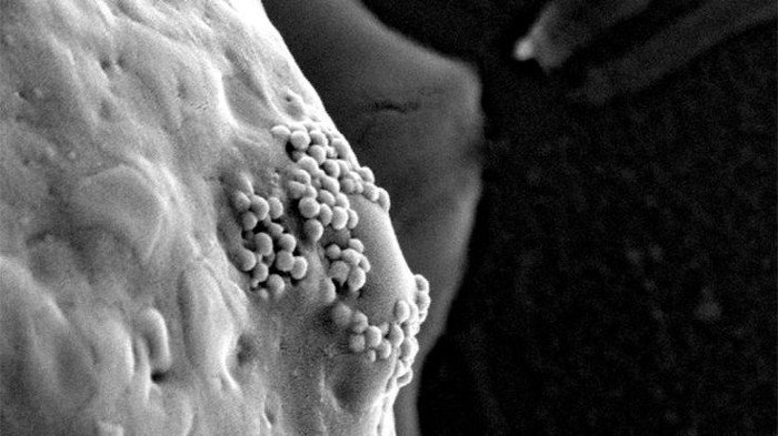 Hạt nano vàng phát nổ có thể tiêu diệt tận gốc tế bào ung thư