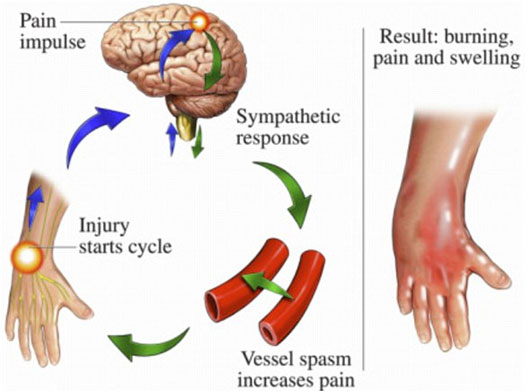 Hội chứng bí ẩn gây đau đớn hơn đau đẻ