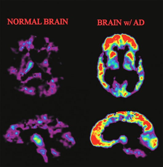 Mô hình mới nhất về nguyên nhân gây bệnh Alzheimer
