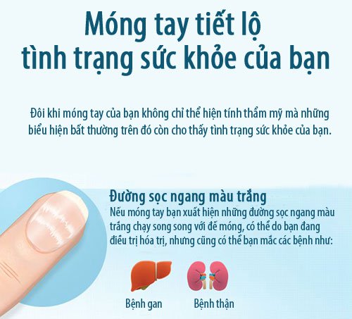 Móng tay tiết lộ sức khỏe của bạn