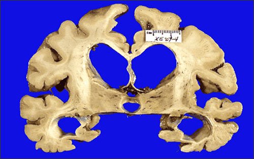 Não teo lại trước khi phát hiện bị bệnh Alzheimer