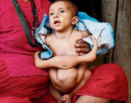 Nepal xôn xao vì em bé có 8 chân tay